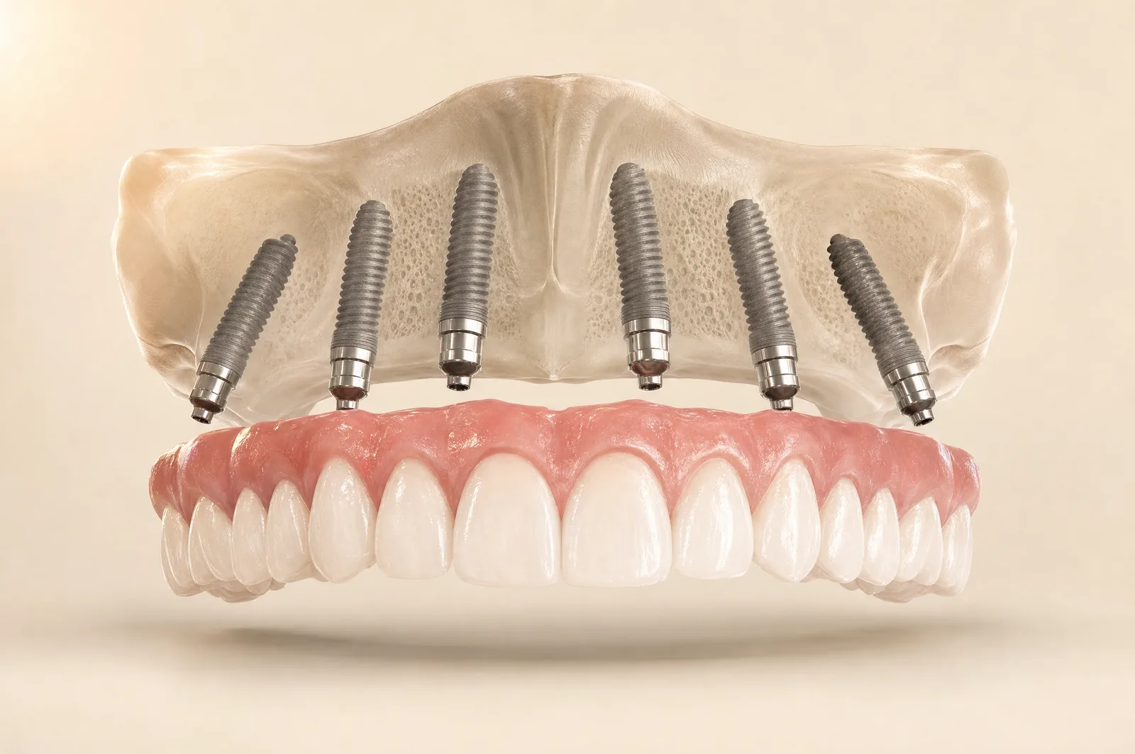 3D render: a full upper arch of fixed teeth supported by six titanium implants in the jawbone