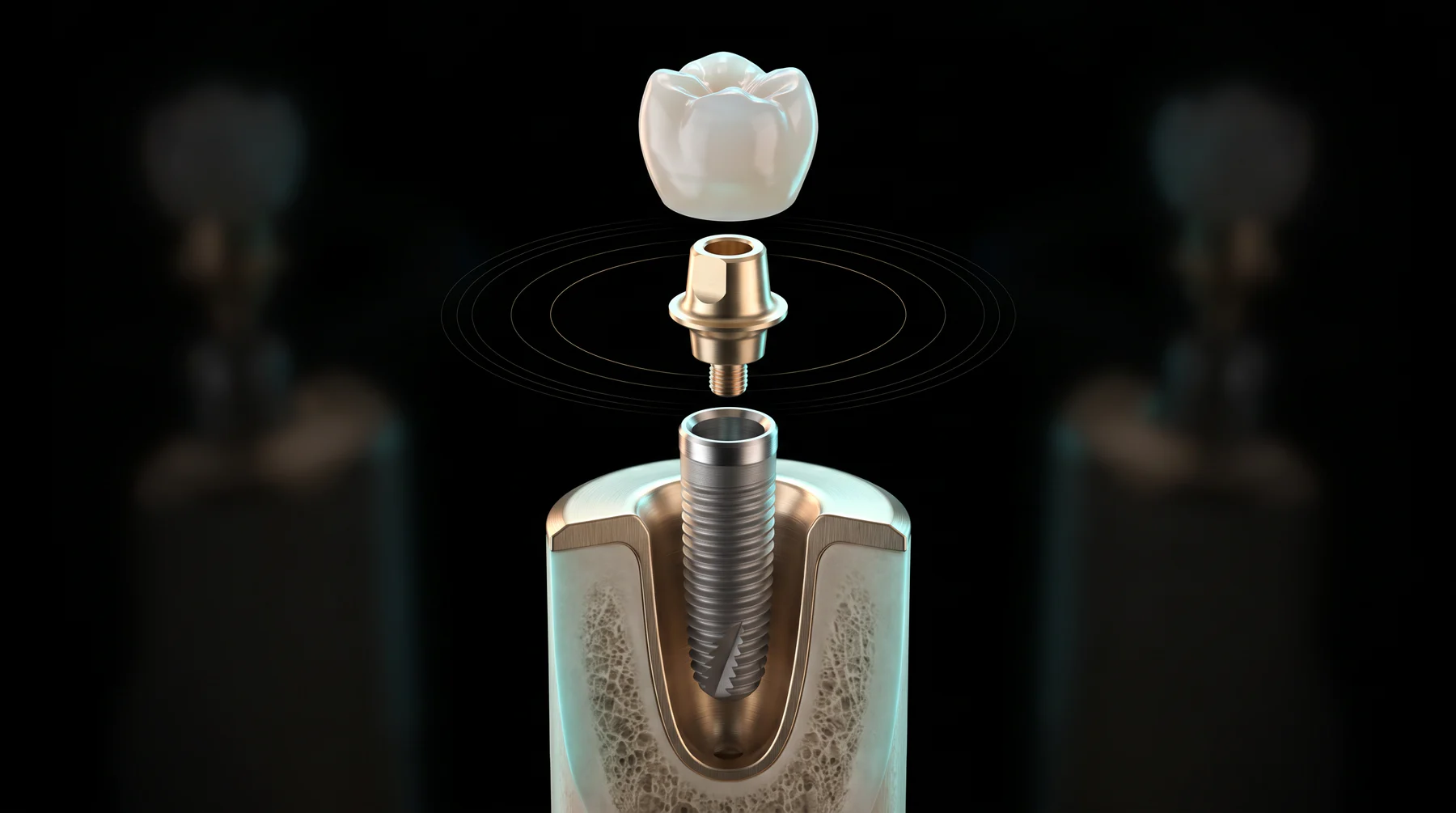 Exploded-view titanium dental implant, abutment and zirconia crown