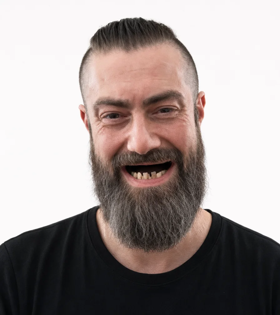 Full Mouth All on 6 Implant Rehabilitation — Before
